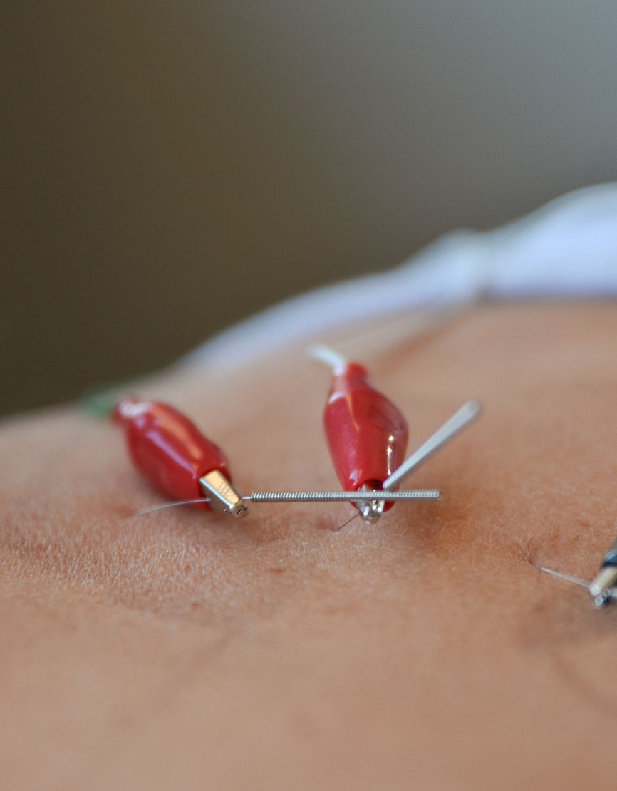 Small wires and clips attached to needles creating a circuit for electro-acupuncture