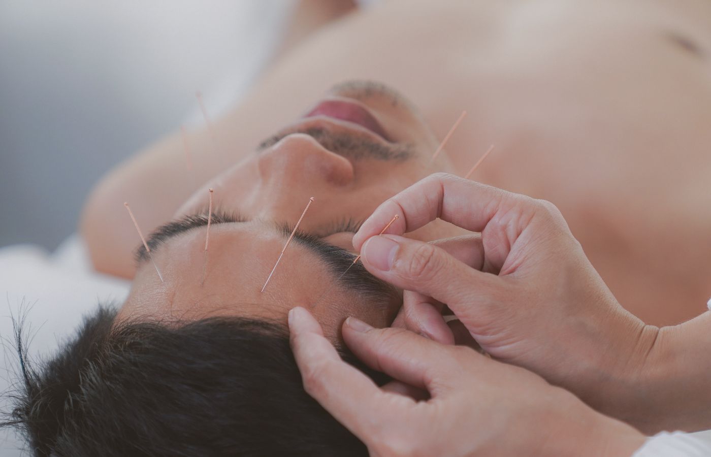 Man receiving facial acupuncture with needles on the forehead