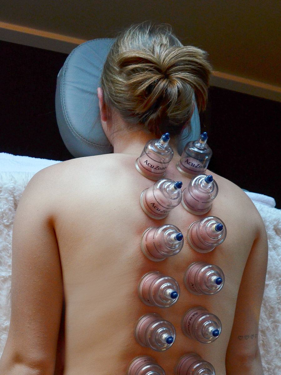 Set of cupping along either side of the spinal column on a Castle Rock Wellness